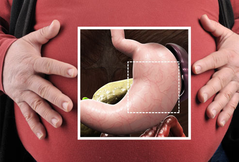 mide-bagirsak-bypass-ameliyatlari